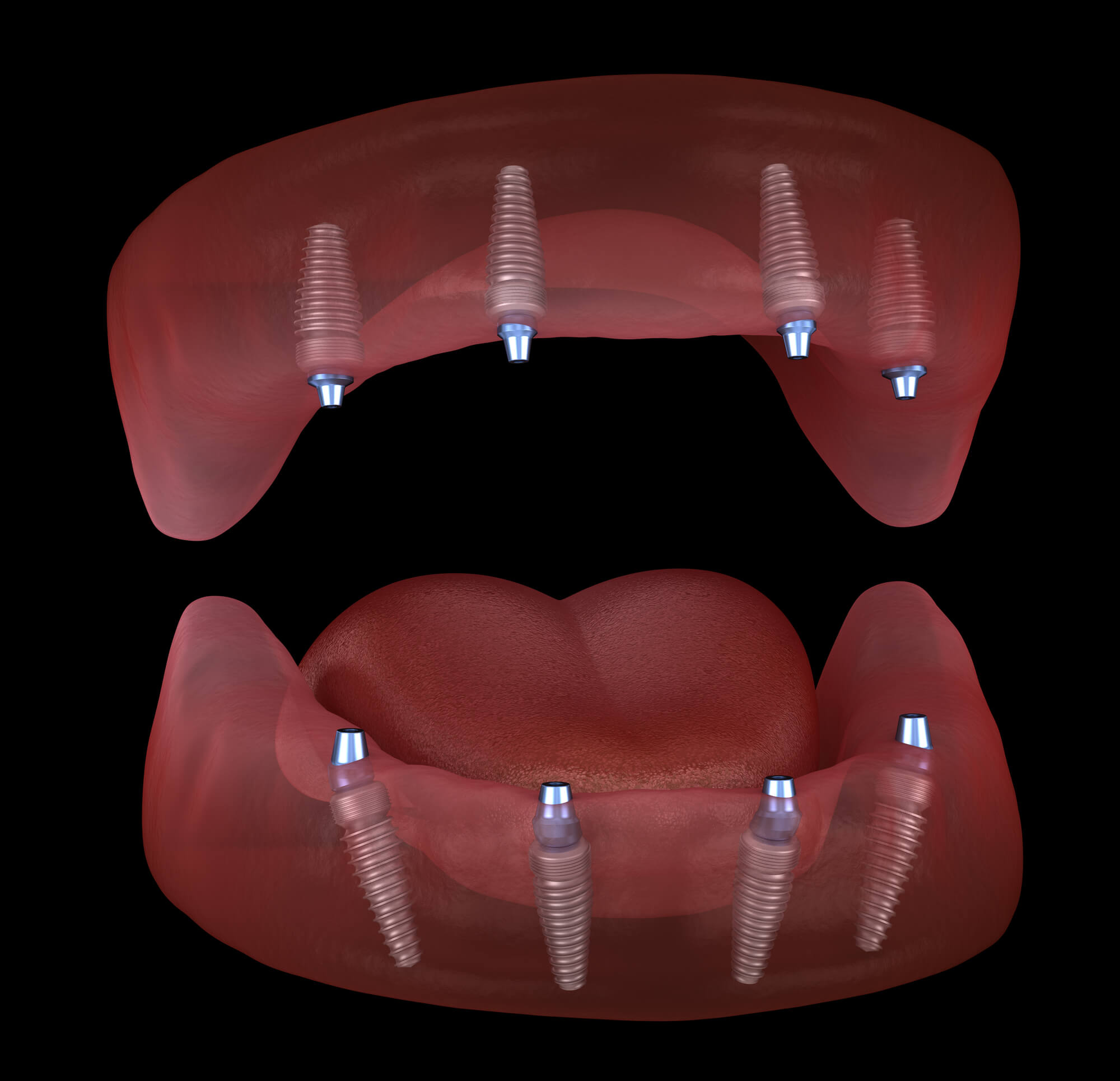 Your Guide to the Allon4® Dental Implant Procedure